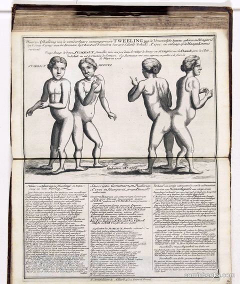 Siamese Twins from Hungary